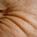 Image of wrinkles in skin